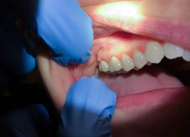 Best Lost Filling or Crown Replacement in Bacliff, TX